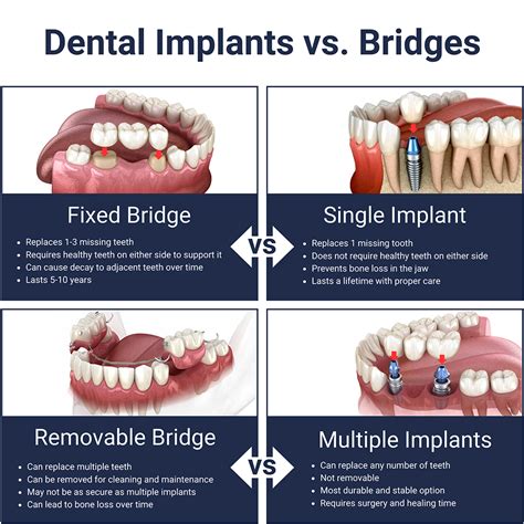bridge implant in ashford